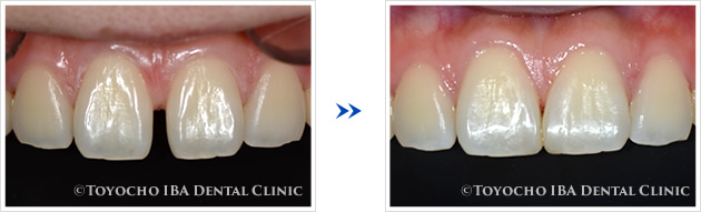 前歯のダイレクトボンディング症例