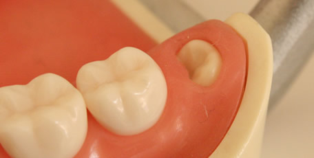 親知らずの抜歯と歯の移植