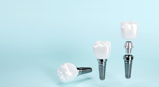 歯科プラント治療